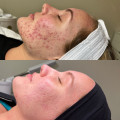 What is the first treatment for acne?