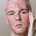 What is the most extreme acne treatment?