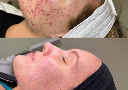 What is the first treatment for acne?