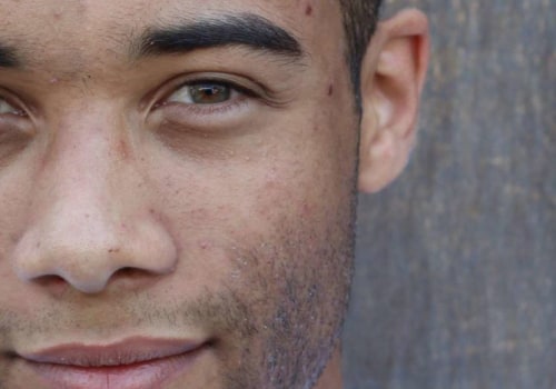 Dark Spot Treatments for Men: Achieve Clear and Healthy Skin