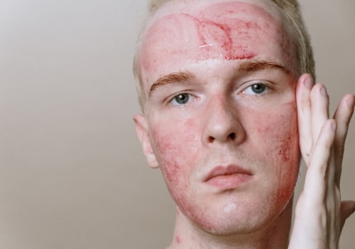 What is the most extreme acne treatment?